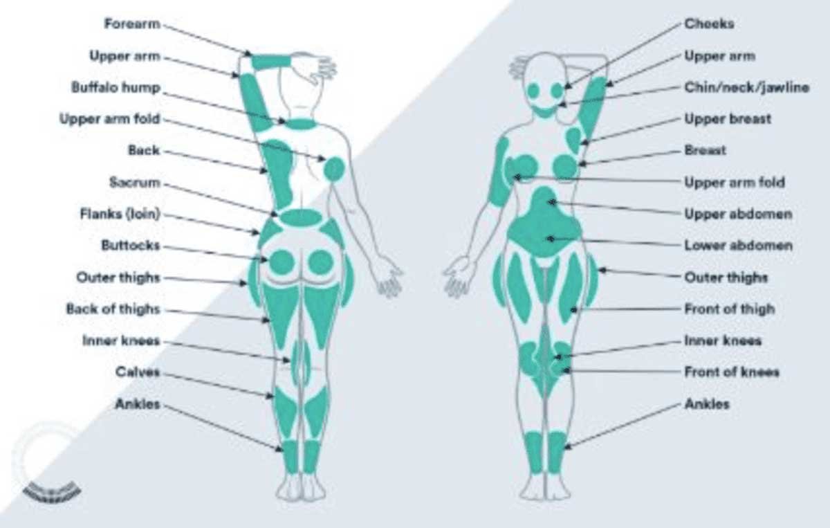 Target areas for liposuction