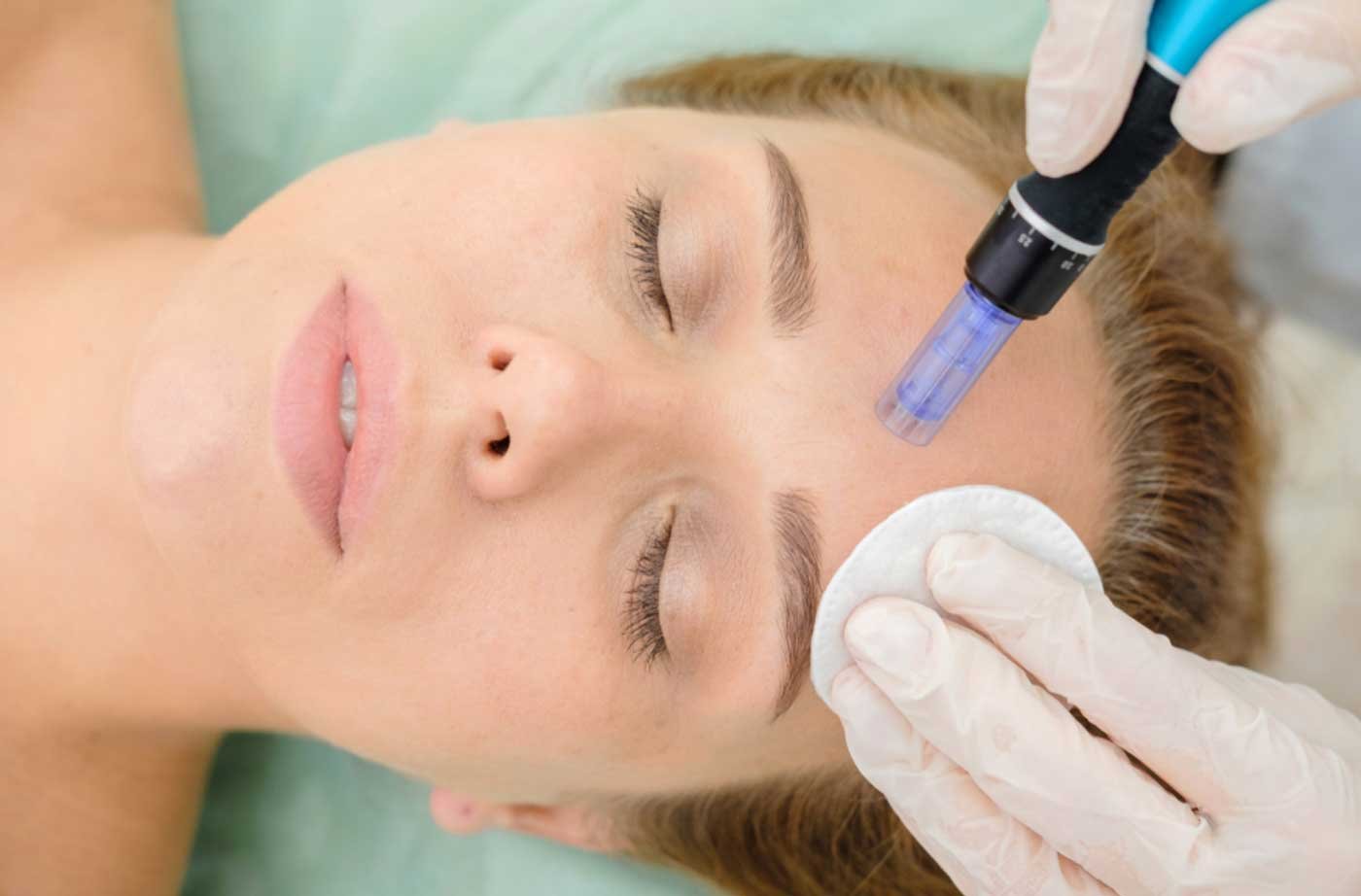 Why are Celebs obsessed with Microneedling