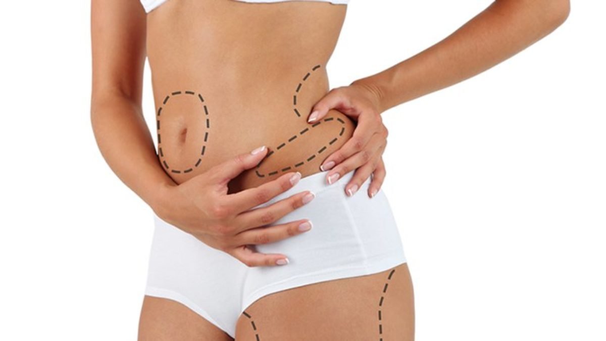 liposuction facts
