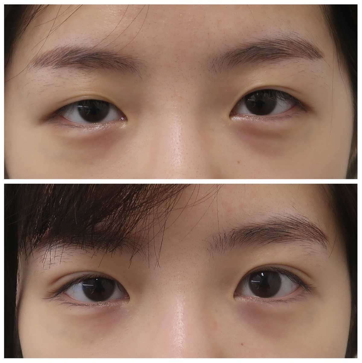 Double eyelid surgery gives noticeable results