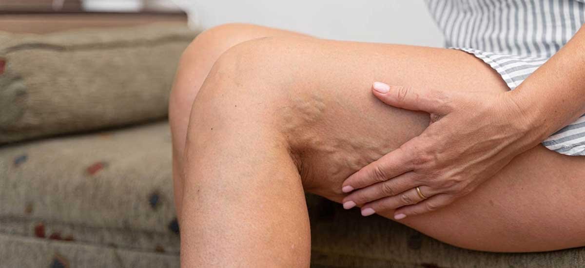 What causes spider veins