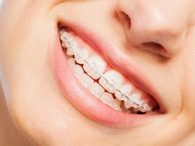 Types of Braces Available For Your Teeth