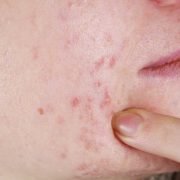 What Is Fungal Acne