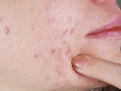 What Is Fungal Acne