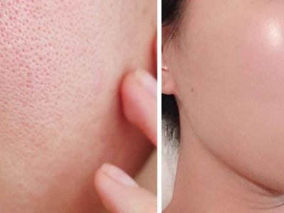 Best Remedies to Minimize Clogged Pores and Get Glowing Soft Skin