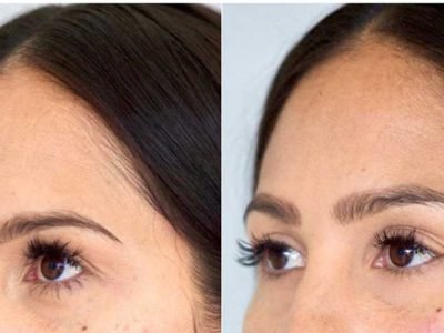 Botox-on-the-`brows