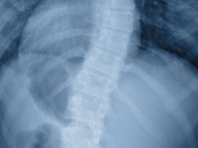 6 Scoliosis symptoms and treatment