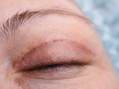 Eyelid Surgery in Singapore